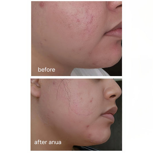 Anua Azelaic Acid 10+ Hyaluron Redness Soothing Serum 30ml